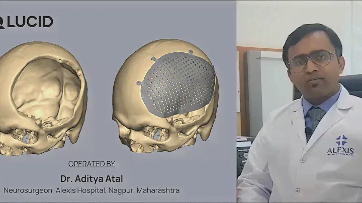 FTP Cranioplasty using 3D Printed Custom Titanium Cranial Plate